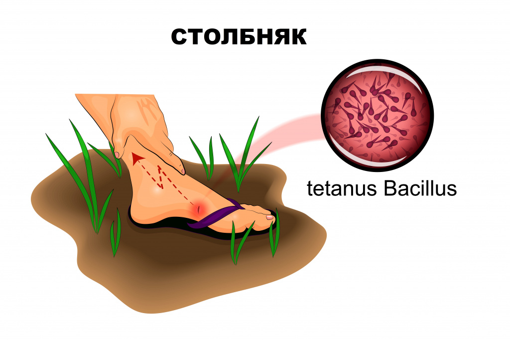 Столбняк